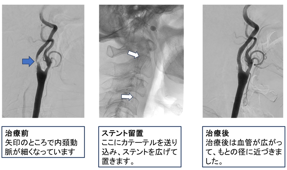 内頚動脈狭窄症の治療手順