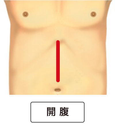 開腹手術の傷口イメージ