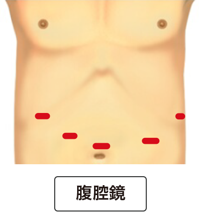 腹腔鏡手術の傷口イメージ