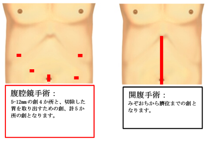 完全腹腔鏡下手術　写真2