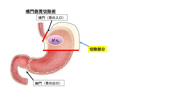 噴門側胃切除　図解１