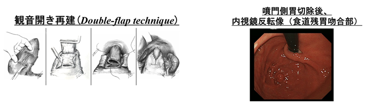 噴門側胃切除　再建写真