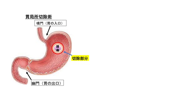 胃局所切除術 図解１