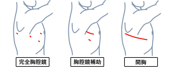 胸腔鏡手術
