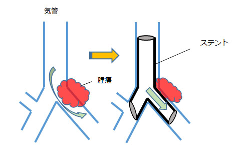 気管支鏡インターベンション（気管支鏡による治療）