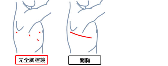 胸腔鏡手術とは?