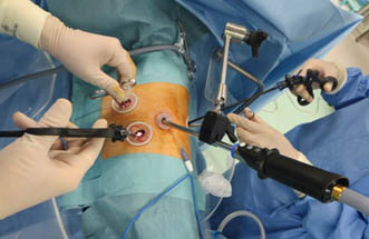 当科の完全胸腔鏡手術の方法