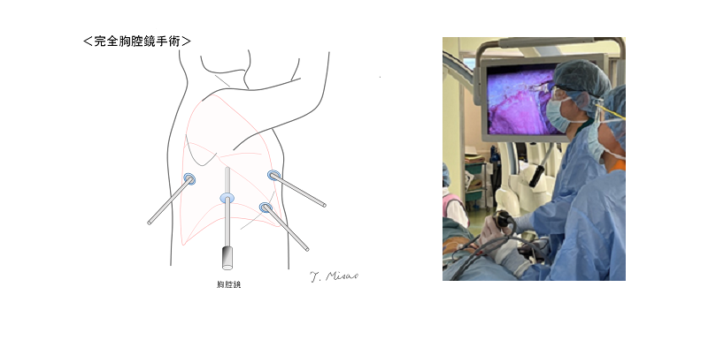完全胸腔鏡手術　イラスト