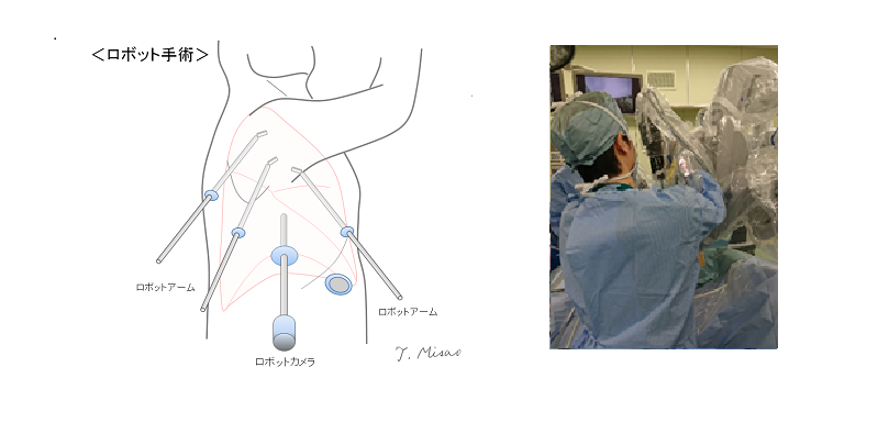 ロボット支援下肺癌手術 イメージ
