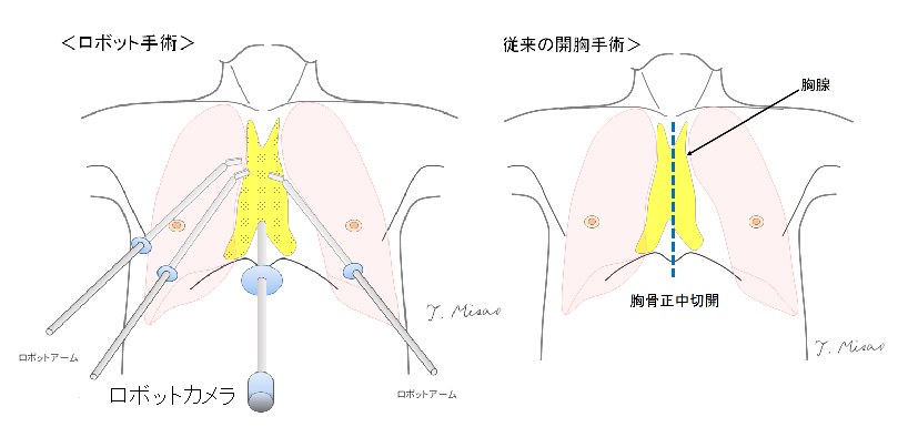 ロボット支援下縦隔腫瘍手術イメージ