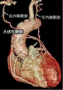 冠動脈バイパス術後のCT