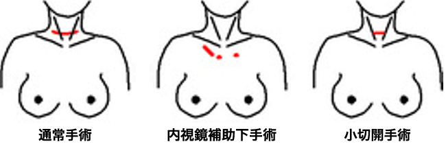 低侵襲性手術