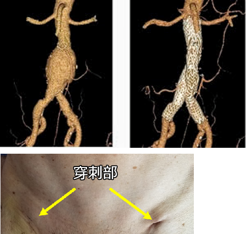 腹部大動脈瘤に対するステントグラフト内挿術