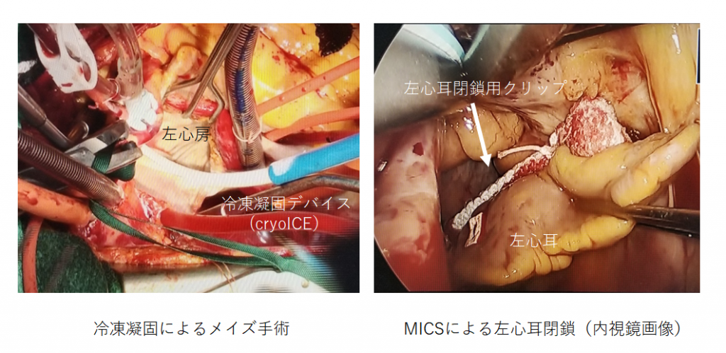 不整脈関連手術写真