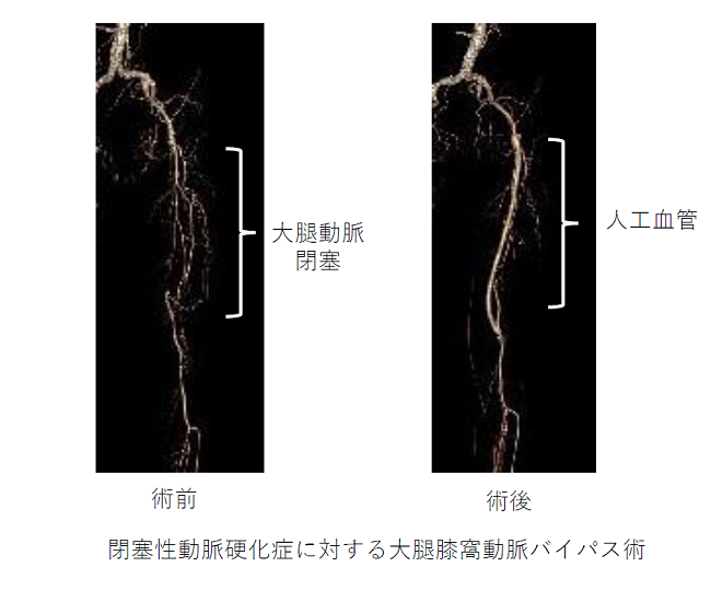 末梢血管手術前後の写真