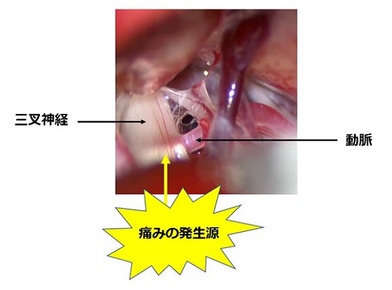 手術により原因となっている動脈を神経から外しているところです。