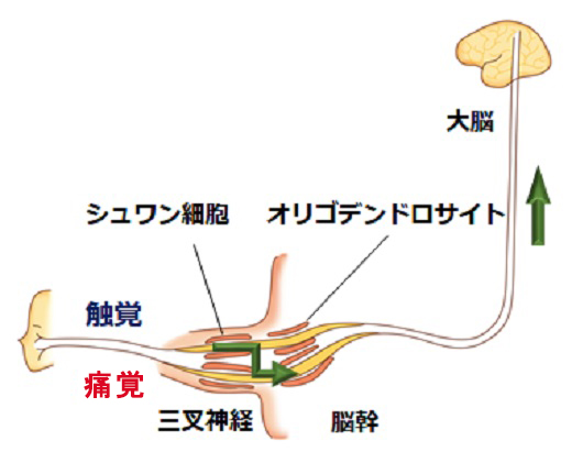 三叉神経痛　原因　画像2