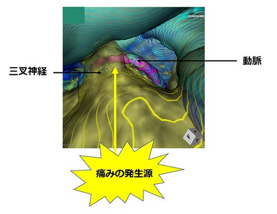 MRIとCT画像をもとに作成した3D画像