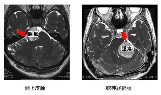 三叉神経の近くに発生した大きな脳腫瘍