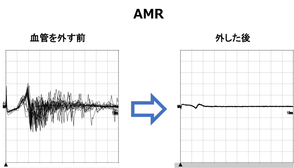 手術中のAMRの波形の変化