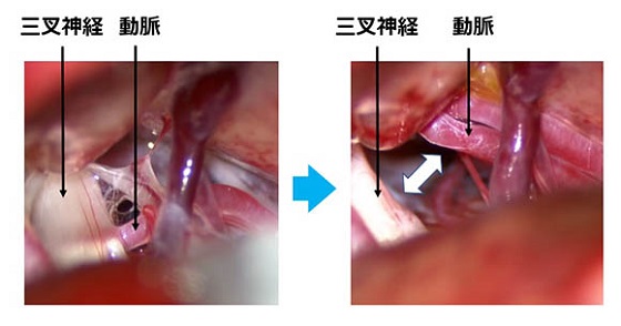 ３．手術 ｢微小血管減圧術｣