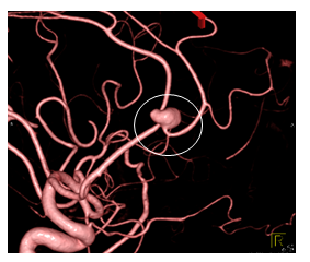 未破裂動脈瘤の写真