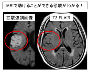 MRIで助けることができる領域がわかる