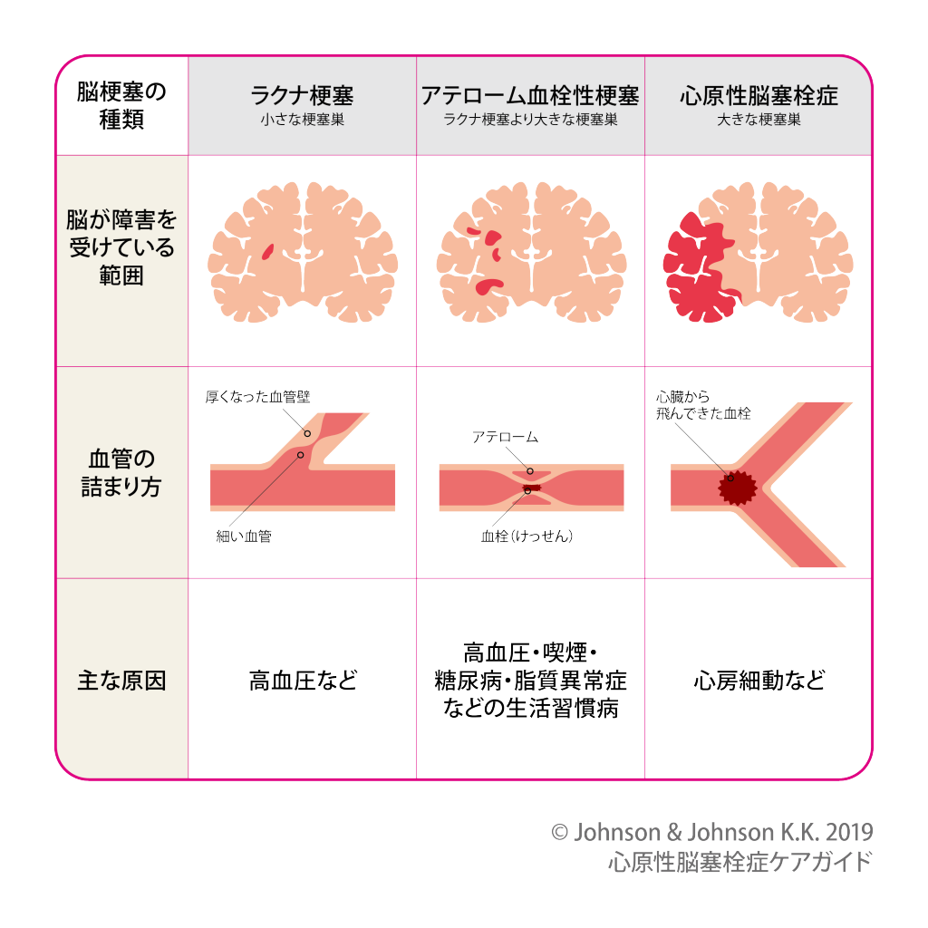 脳梗塞の種類