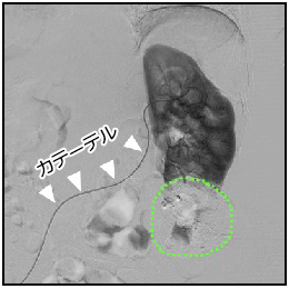 カテーテル治療　写真2