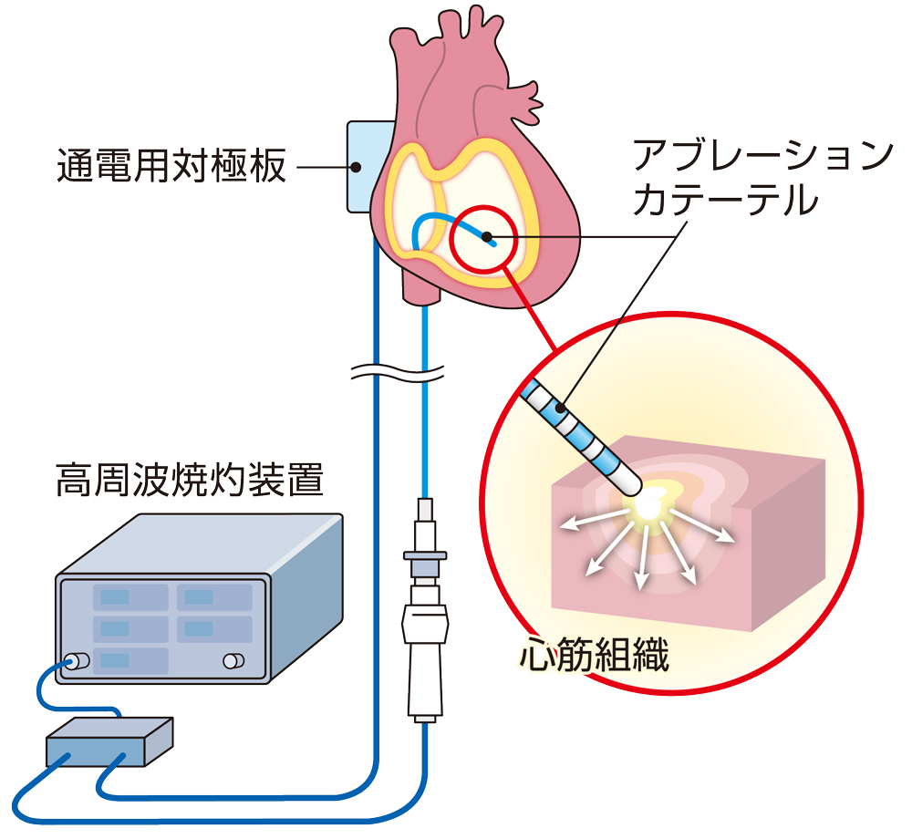 カテーテルアブレーションの解説図