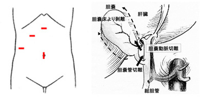 腹腔鏡下手術（標準）