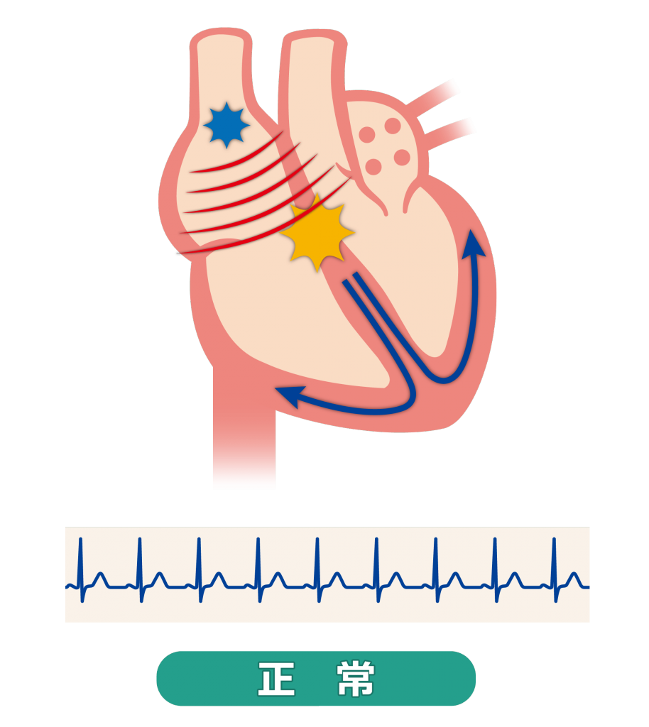 正常な心臓