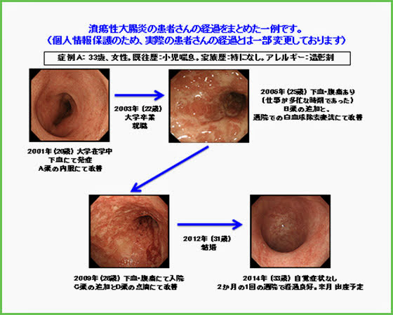 当院で治療を受けられているIBDの患者さんの発症からの経過、検査や手術などの情報一例