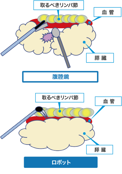 胃がんに対するロボット支援手術の特徴