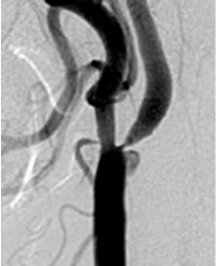 図：頸動脈分岐部の内頸動脈起始部で血管が高度に狭窄しています。