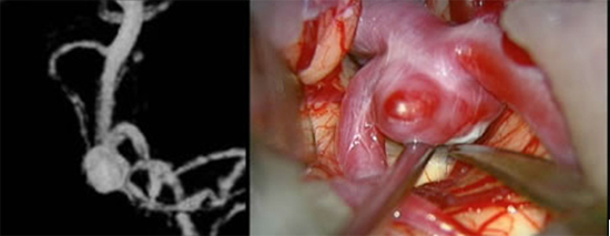 図1：未破裂脳動脈瘤の3次元血管撮影像と術中写真