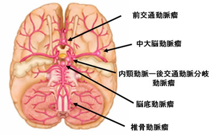 図2:代表的な瘤の発生部位