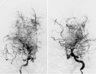 図2 脳血管撮影