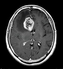 前頭葉に発生したグリオーマのMRI画像