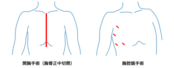 縦隔腫瘍