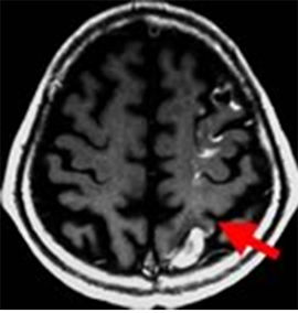 頭部MRI 白いところが梗塞脳血管造影