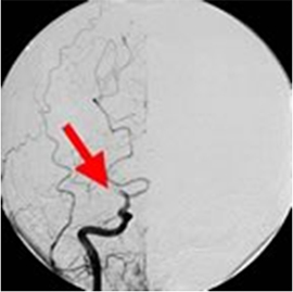 脳血管造影
矢印のところで血管がつまっている