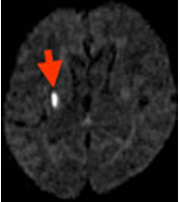 頭部MRI
拡散強調画像