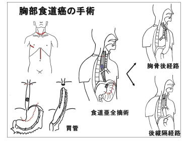 胸部食道癌の手術