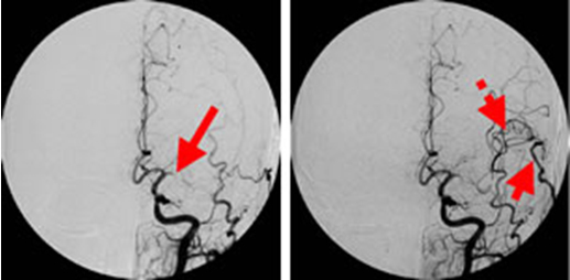 左；術前：矢印のところで 血管がつまっている
右；術後：実線；吻合した皮膚血管 　点線；吻合血管からつながった頭蓋内血管