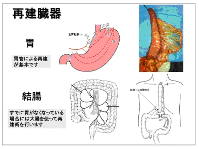 再建臓器