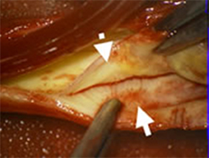 術中所見
実線；血管壁
点線；剥離中の肥厚した内膜