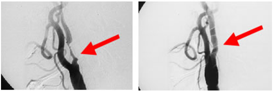 脳血管造影検査 術前狭窄あり 術後狭窄が改善している