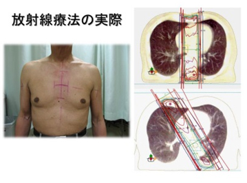 放射線治療の実際