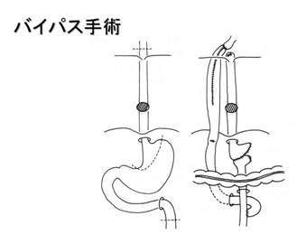 バイパス手術